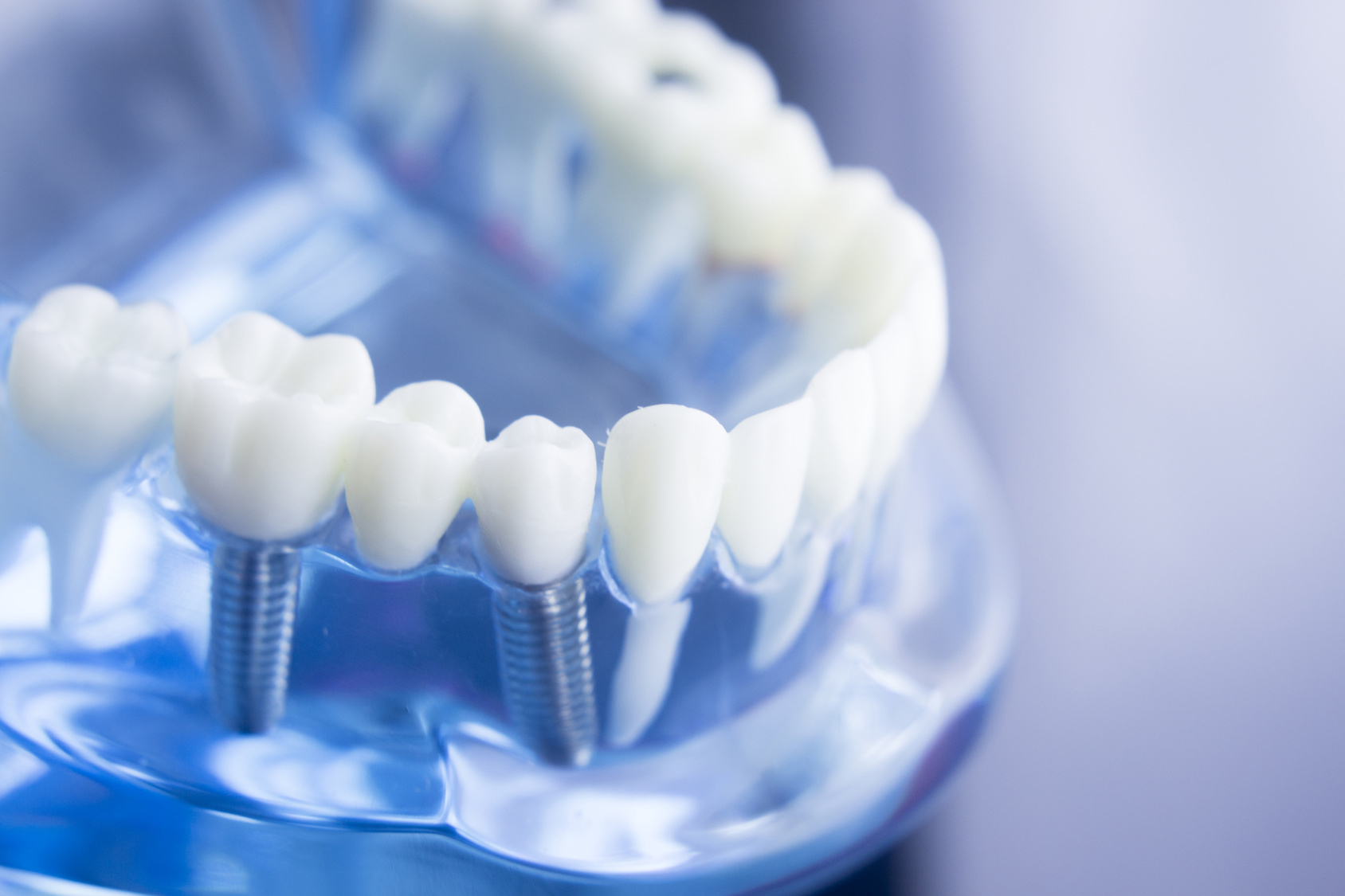 Implante osteointegrado dental, ¿qué es?