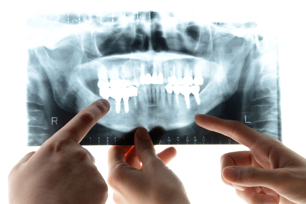 ¿Qué ventajas tienen los implantes frente a las prótesis removibles?