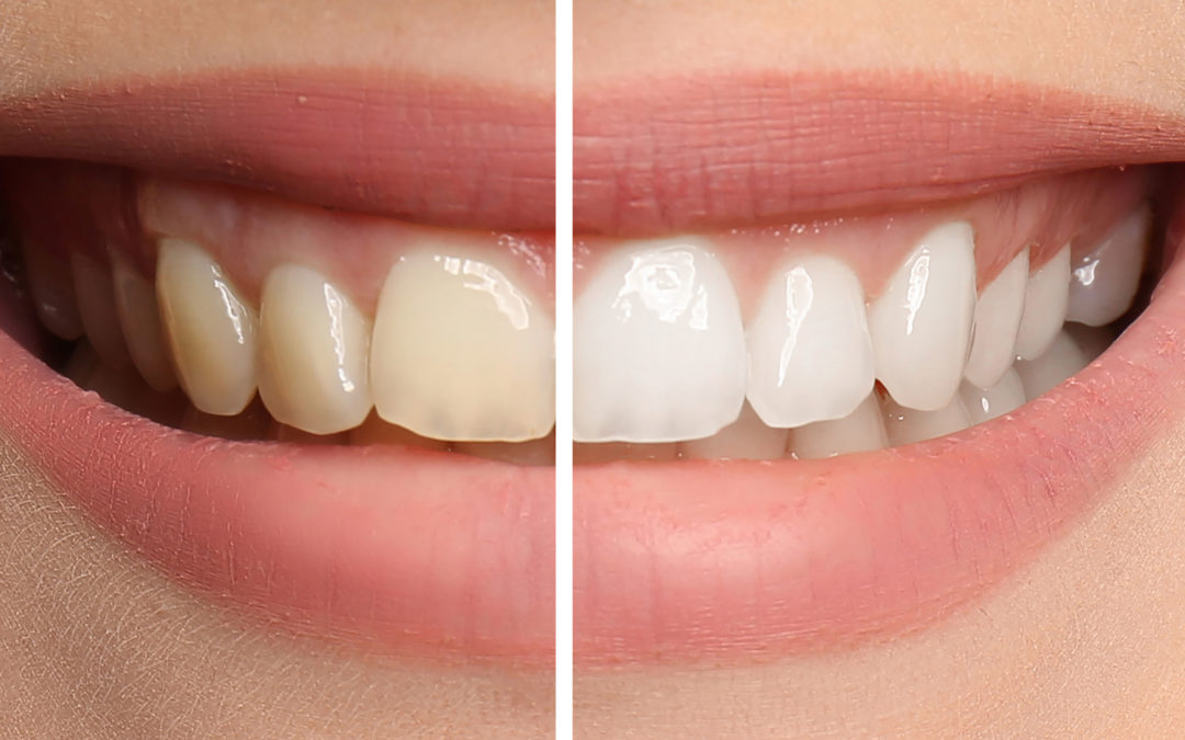 Hay alimentos que blanquean los dientes